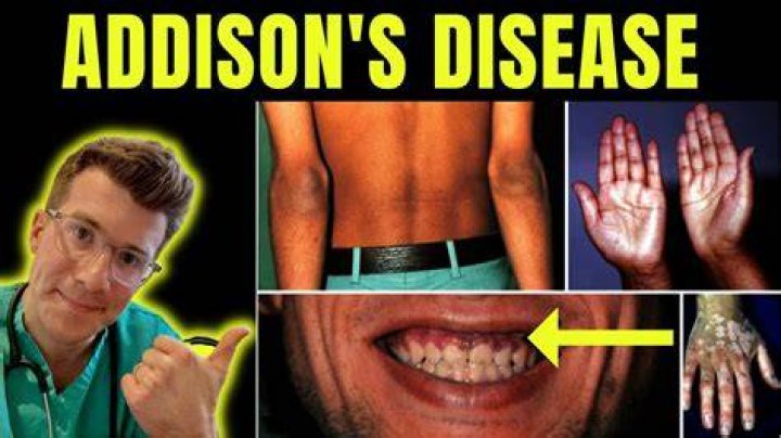 Kodi Lee Has Addison’s Disease – Here Is An Update On The Singer’s Health And Diagnosis